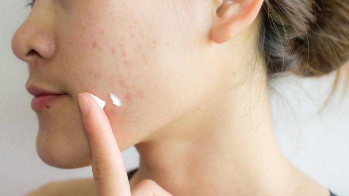 6 Obat Totol Jerawat Terbaik untuk Mengatasi Jerawat dan Bekasnya