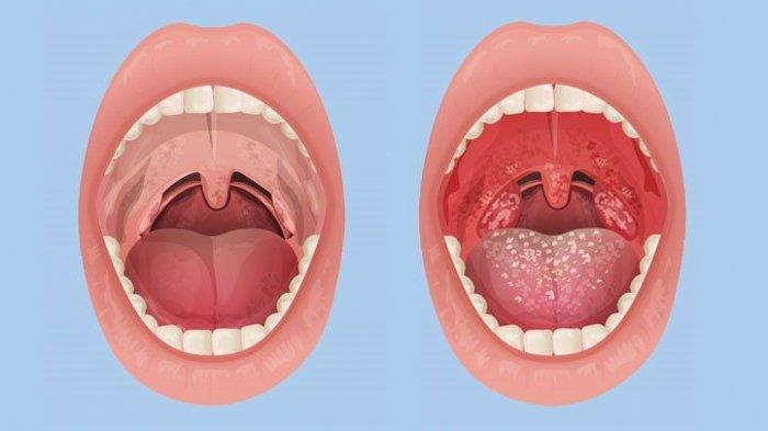 Mengenal Ciri ciri Amandel, Diagnosis, dan Cara Mengatasinya