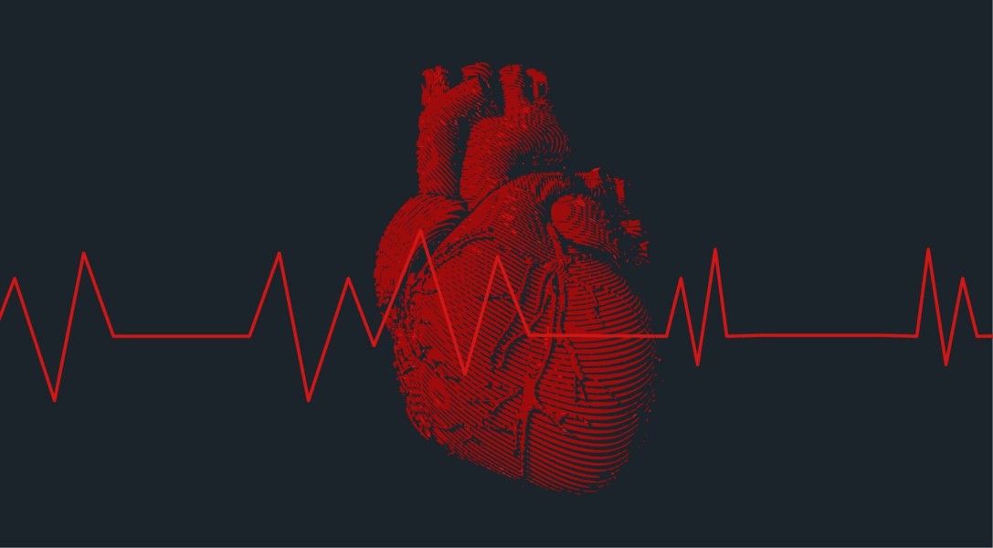 Mengenal Gejala dan Faktor Pemicu Fibrilasi Atrium, Gangguan Irama Jantung Berbahaya