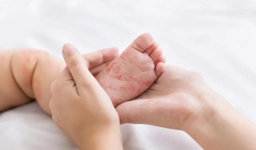 Cegah Penularan, Kemenkes Minta Anak Campak Diisolasi