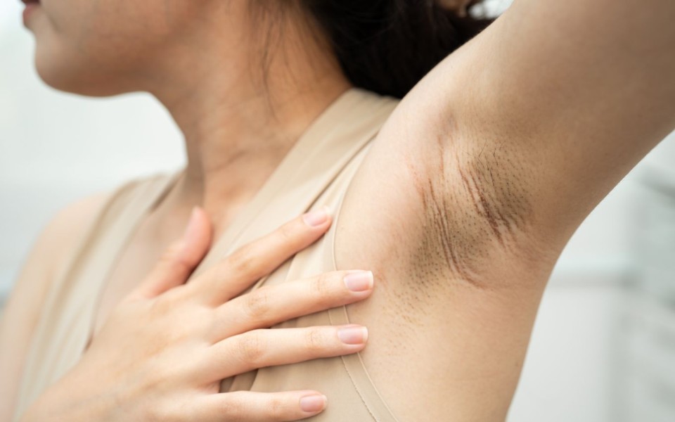 6 Cara Menghilangkan Chicken Skin Ketiak Agar Halus dan Cerah