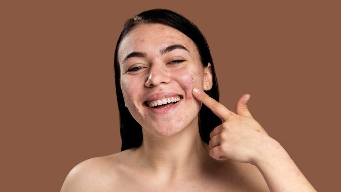 Cara Ampuh Menghilangkan Bekas Jerawat dengan Skincare dan Perawatan Alami