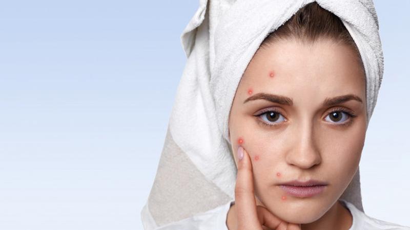 Hindari 7 Kesalahan Ini Agar Wajah Berjerawat Cepat Pulih