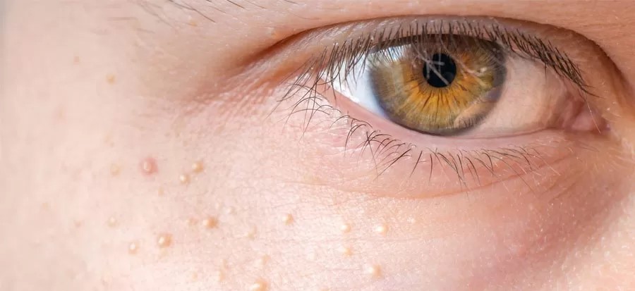 Cara Ampuh Atasi Milia Membandel Bertahun-Tahun di Wajah