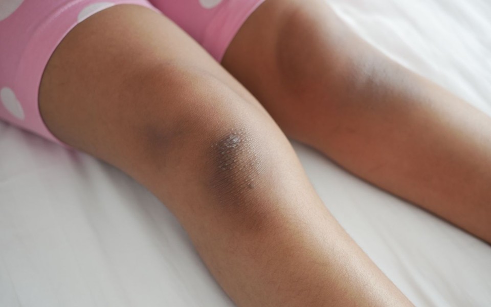 Cara Aman dan Efektif Mencerahkan Lutut Gelap Tanpa Menggosok Kasar