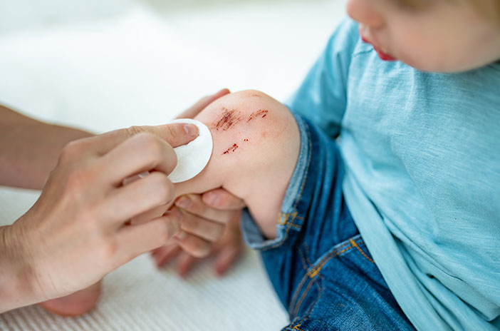 Merawat Luka Anak Menurut Dokter