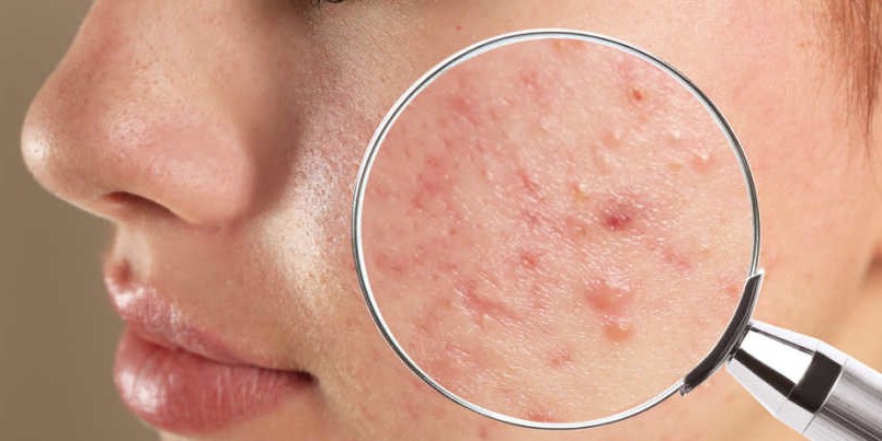 Stres Bisa Menyebabkan Jerawat, Begini Cara Mengatasinya