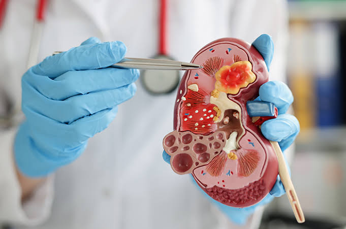 5 Tanda Perubahan Kulit yang Bisa Menunjukkan Kerusakan Ginjal Kronis