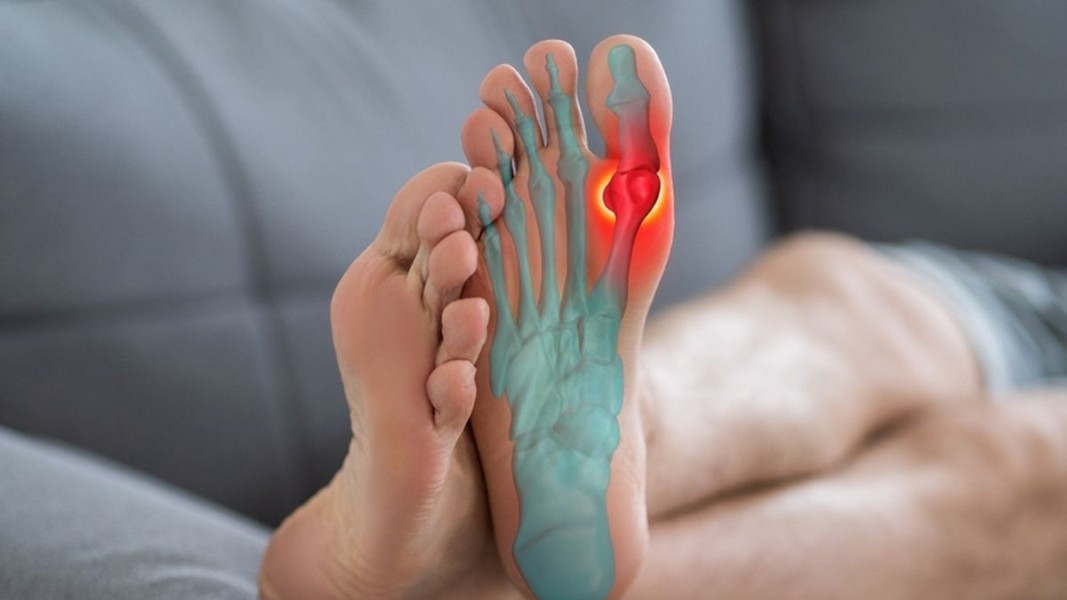 Cara Praktis Membedakan Asam Urat dan Rematik Agar Tidak Salah Penanganan