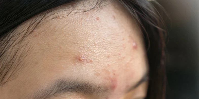 Jerawat di Dahi Sering Muncul Ini Penyebab dan Cara Mengatasinya