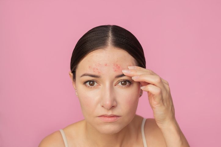 Jerawat Hingga Rambut Rontok, Tanda Stres yang Diam-Diam Muncul di Kulit