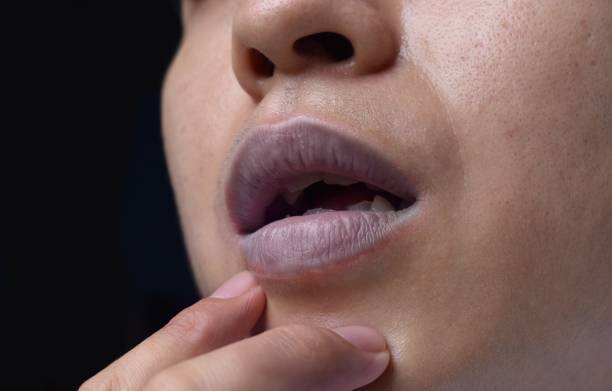 Deteksi Dini Bibir Biru Bisa Menyelamatkan Nyawa dalam Kondisi Darurat