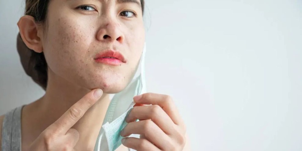14 Cara Mencegah Jerawat Secara Alami, Dijamin Ampuh!