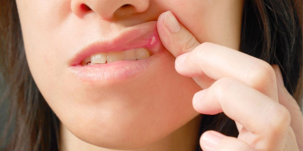 Cara Mencegah Sariawan Agar Tidak Kembali Lagi