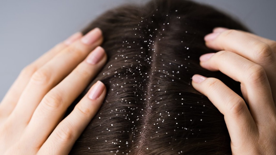 Bebas Ketombe: 12 Sampo Terbaik untuk Rambut Sehat