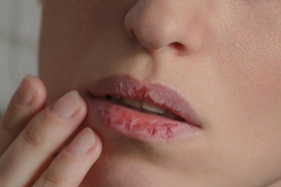 Penyebab Hingga Cara Mengatasi Bibir Pecah Pecah Dan Menghitam