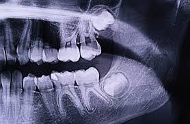 Biaya Operasi Impaksi Gigi di Klinik hingga Rumah Sakit