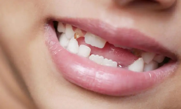 Kesadaran Perawatan Gigi Anak Masih Rendah, Risiko Serius Mengintai Keluarga