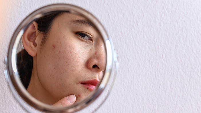 Cara Efektif Mengurangi Jerawat Hormonal dengan Perawatan Kulit Tepat dan Aman