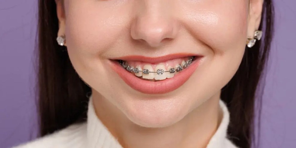 Apa Saja Kelebihan dan Kekurangan Behel Self-Ligating? Simak Ini!