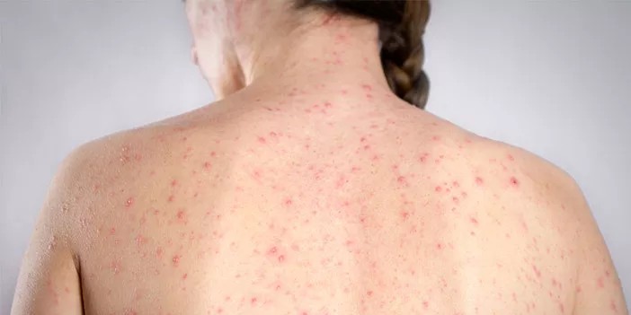 Mengapa Campak pada Dewasa Bisa Lebih Berat? Ini Jawabannya