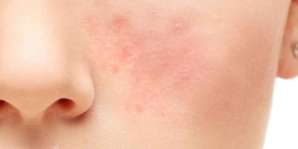 Kulit Wajah Gatal? Kenali Penyebab dan Cara Mengatasinya