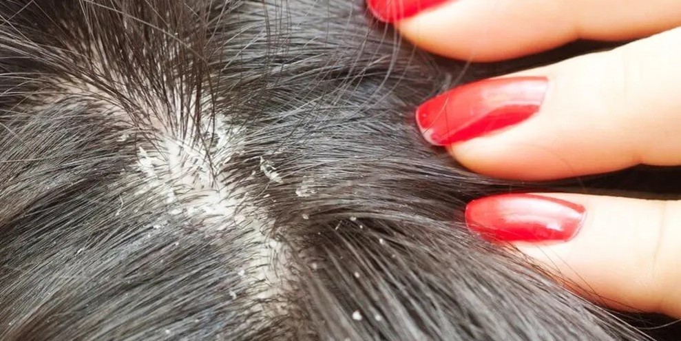 Cara Ampuh Atasi Kulit Kepala Kering dengan Mudah