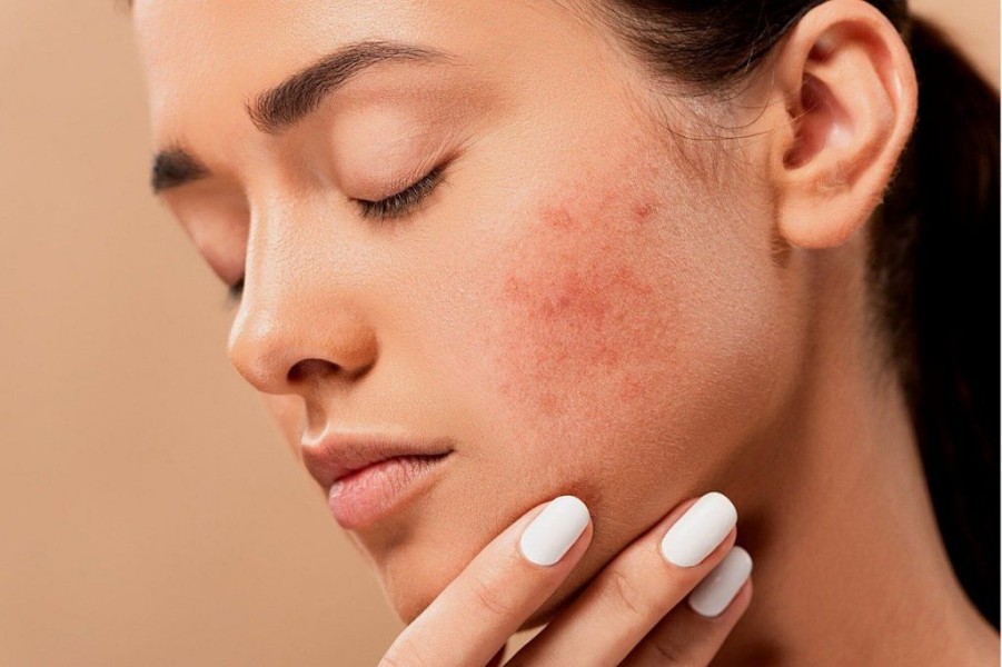 Skin Barrier adalah: Fungsi, Kerusakan, dan Cara Menjaganya