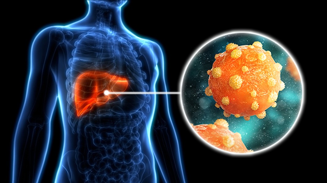 Dokter Jelaskan Penyebab Meningkatnya Kasus Hepatitis di Aceh