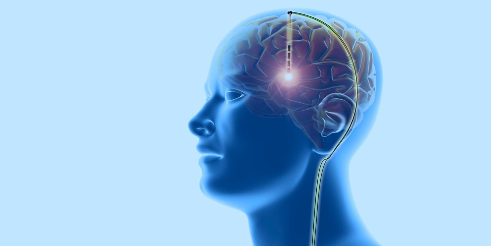 Mengenal Deep Brain Stimulation untuk Bantu Parkinson Lebih Terkontrol