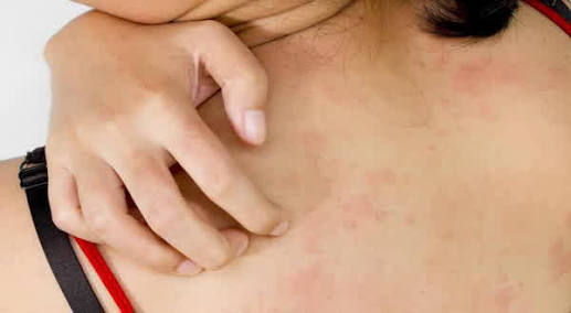 Tanda Penyakit Ginjal di Kulit yang Sering Tak Disadari