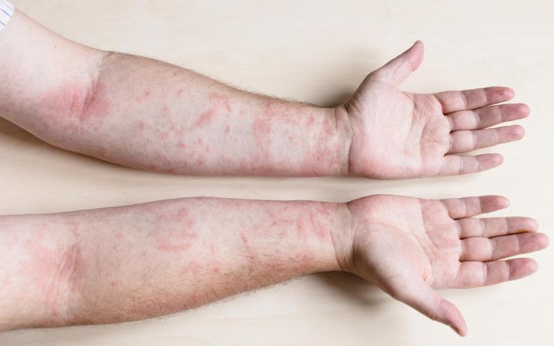 Macam-macam Alergi, Penyebab, Gejala, hingga Diagnosisnya