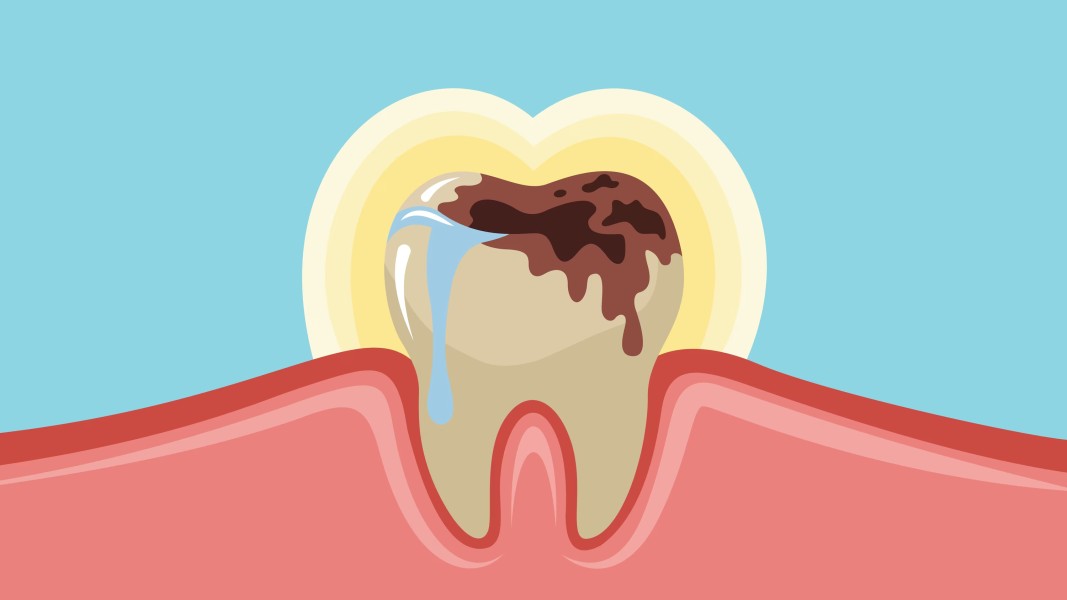 Kenali Proses Terbentuknya Gigi Berlubang dan Cara Pencegahannya yang Efektif