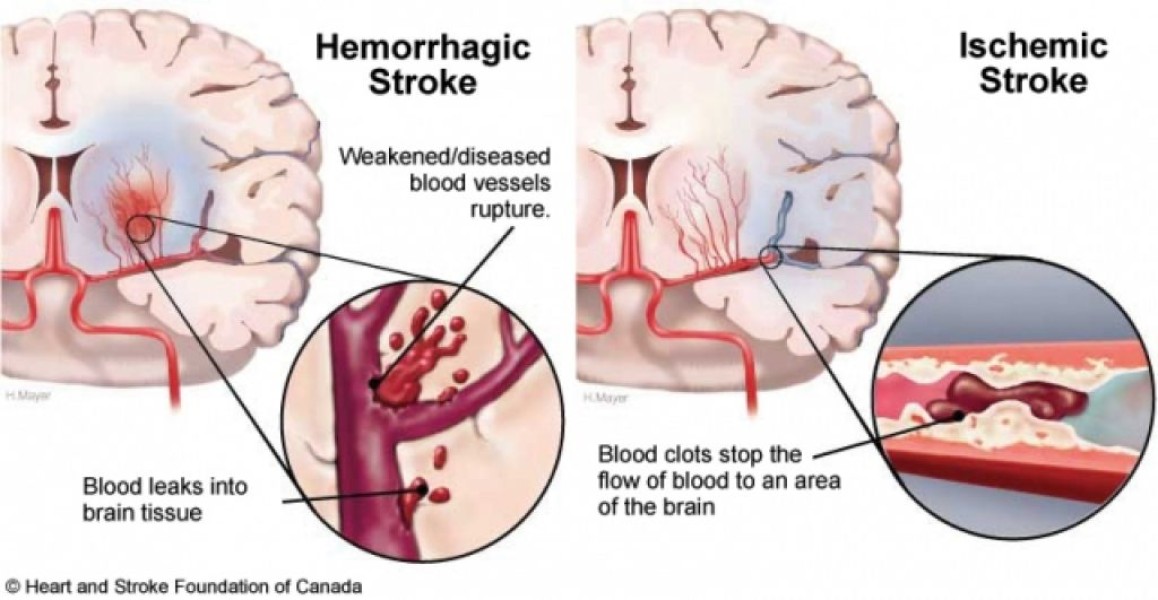 Kenali Stroke Lebih Cepat dengan Metode FAST yang Efektif
