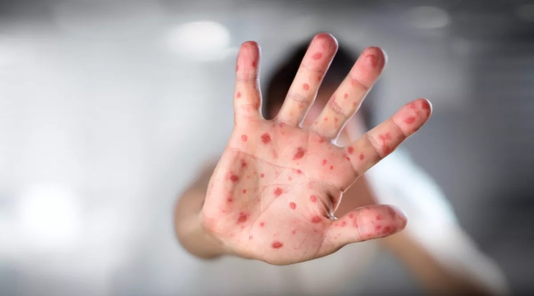 IDAI Rekomendasikan 6 Langkah Strategis Tangani Lonjakan Kasus Campak di Indonesia