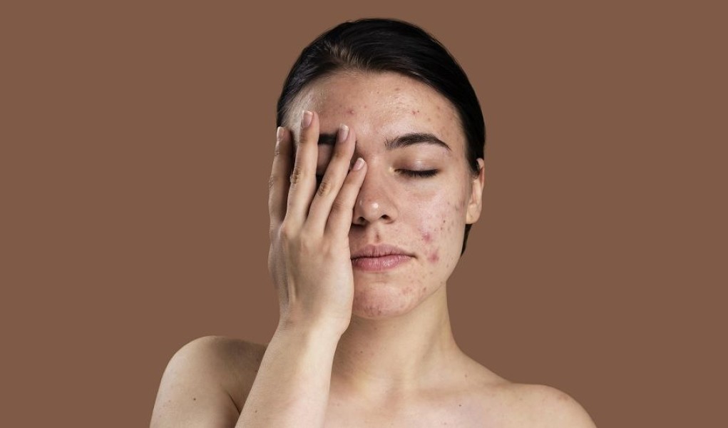7 Urutan Skincare untuk Acne-Prone Skin Menurut Dokter Kulit