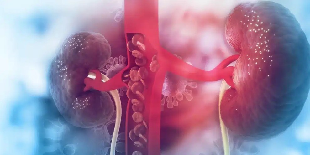 Terapi Anemia pada Pasien PGK Efektif Tingkatkan Kualitas Hidup