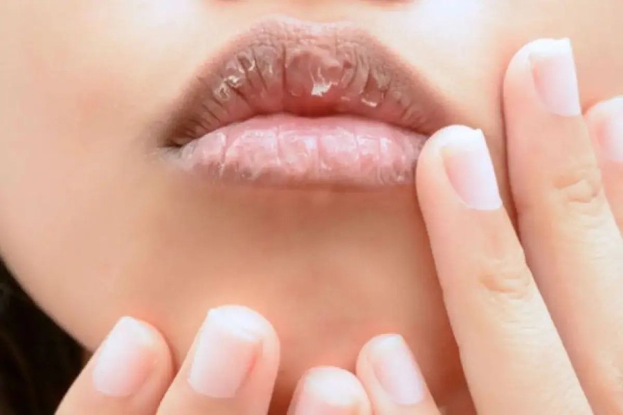 Cara Mengatasi Bibir Kering Terlengkap yang Patut Dicoba