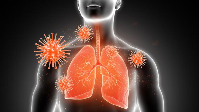 Waspada Terhadap Pneumonia: Kemenkes Sampaikan Imbauan Penting