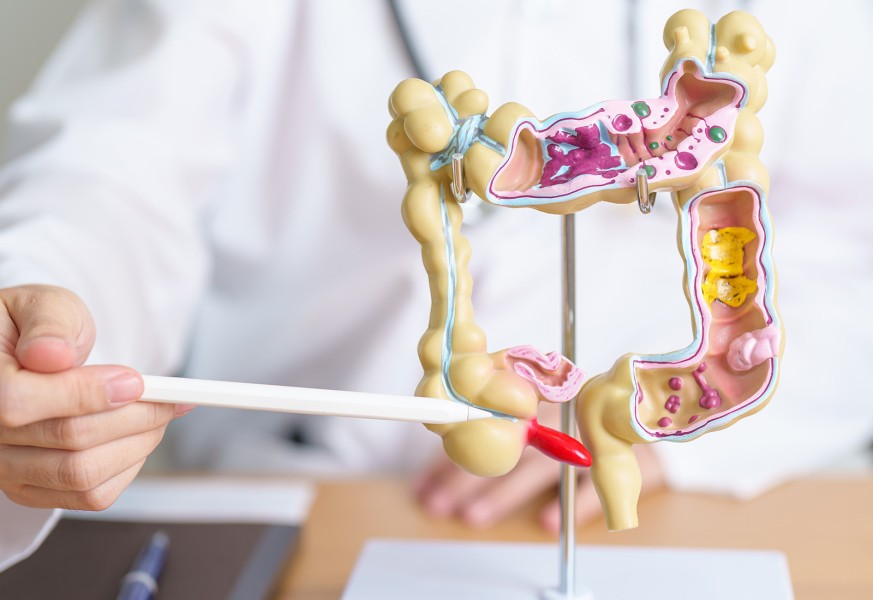 Kenali Bahaya Sumbatan Usus dan Cara Penanganannya dari Dokter Spesialis