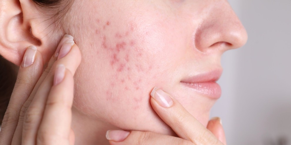 Pentingnya Pola Makan Sehat untuk Mendukung Kulit Bebas Jerawat Secara Alami