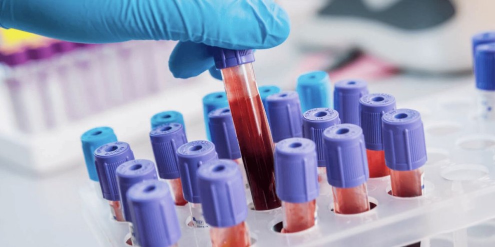 Harga Cek Darah Lengkap Prodia: Waktu, Persiapan, dan Manfaatnya