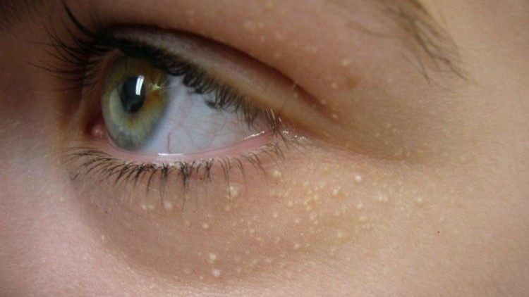 Cara Ampuh Menghilangkan Milia Bertahun-tahun dan Mencegah Kembalinya