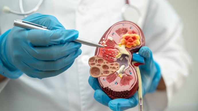 Gagal Ginjal Kronis Sulit Terdeteksi Dini, Ini Penjelasan Dokter