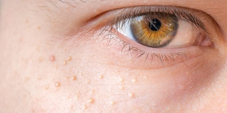 Skincare Tepat Bisa Membuat Milia Hilang dan Kulit Glowing