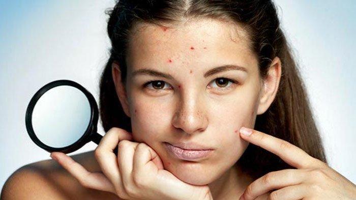 5 Bahan Skincare yang Perlu Dihindari Agar Jerawat Tidak Memburuk