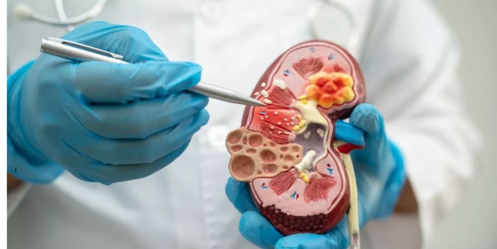 Wajib Tahu, Ini Penyebab dan 10 Cara Mencegah Gagal Ginjal