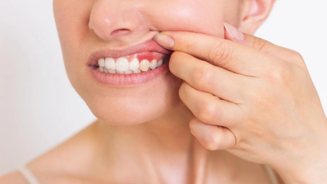 Peradangan Gusi Bisa Mengganggu Kesehatan, Ini Tanda yang Harus Diketahui