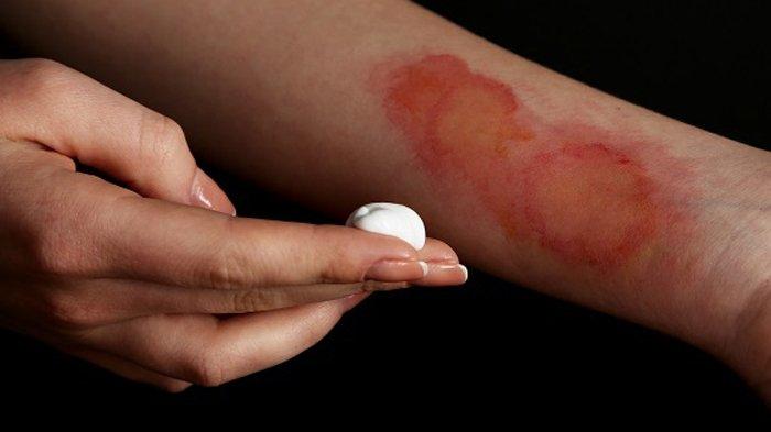 Odol Bisa Mengobati Luka Bakar, Mitos atau Fakta