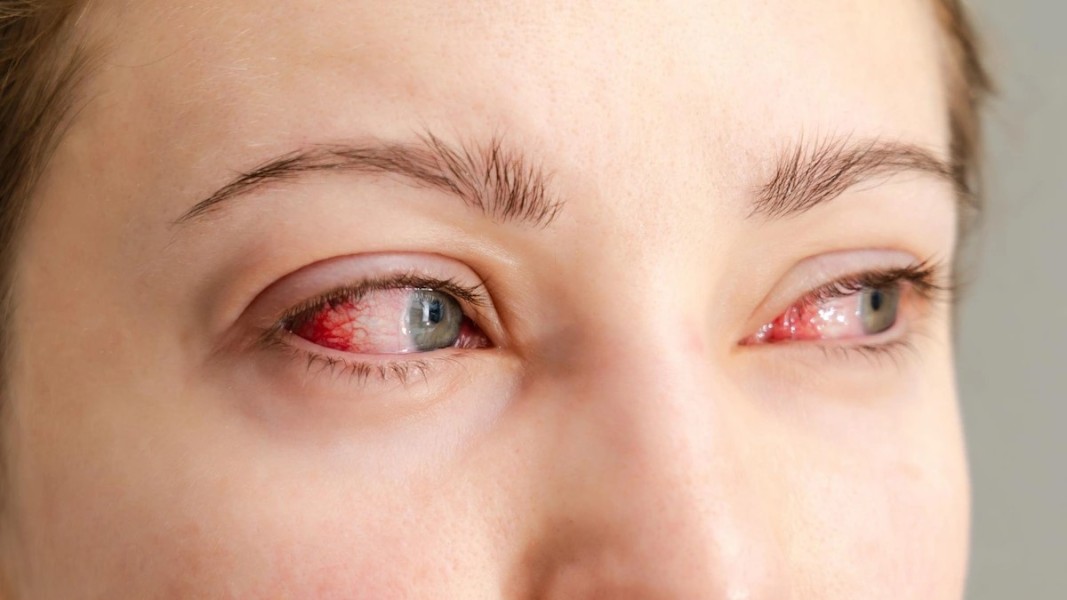 Waspada Stroke Mata, Ancaman Sunyi Penyebab Kebutaan yang Sering Diabaikan